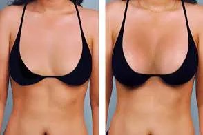 自体脂肪隆胸图片大全