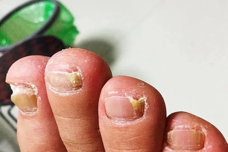 灰指甲图片全图