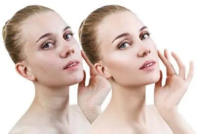 丝瓜皮怎么祛斑