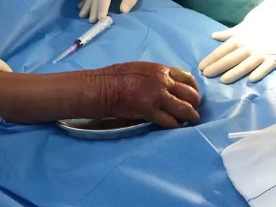 气性坏疽症状图片