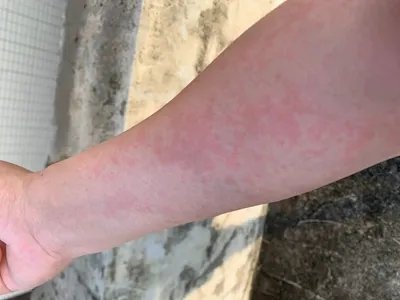 皮肤过敏红肿胳膊症状图片