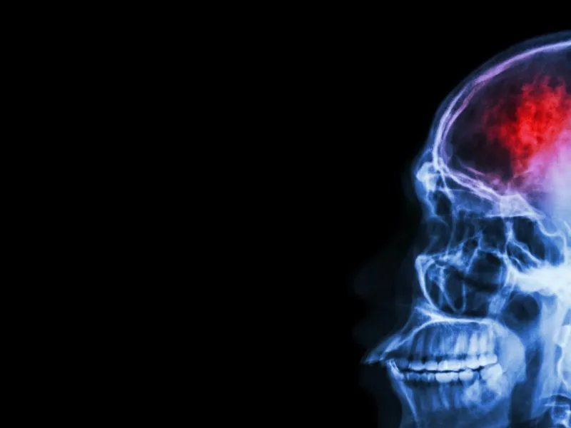 脑卒中筛查什么