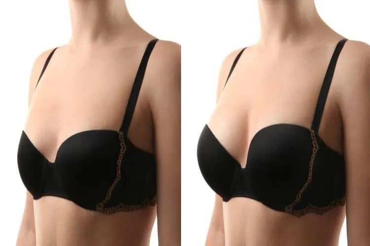 自体脂肪隆胸图片大全