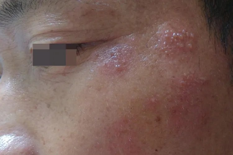 蛇胆疮长脸上的图片