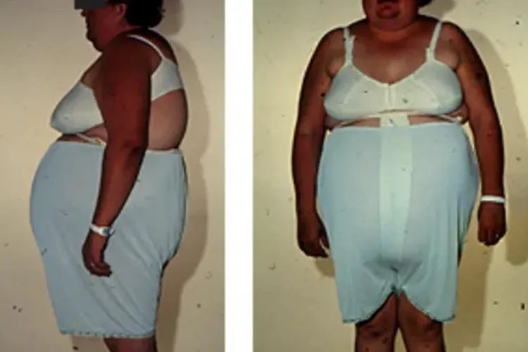 激素水牛背满月脸图片