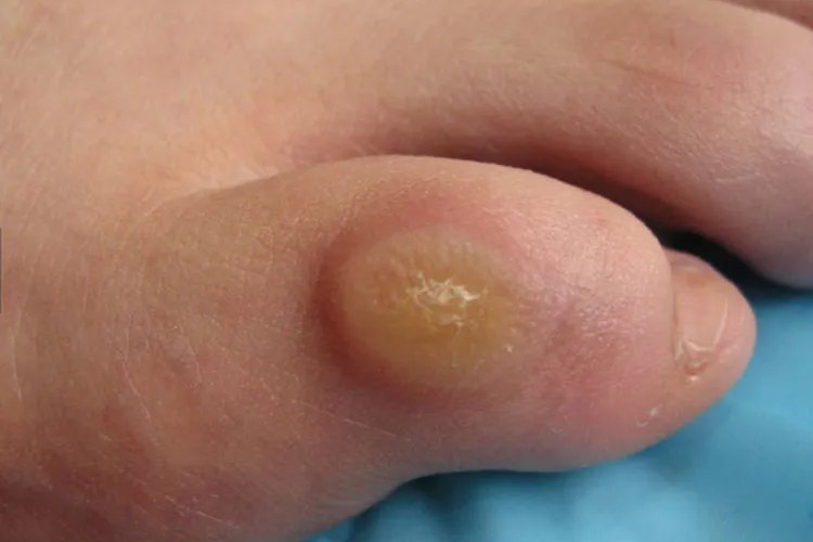 鸡眼一般长在什么位置