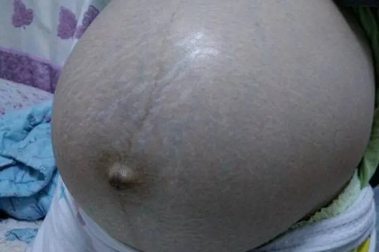 孕妇肚脐眼变化图