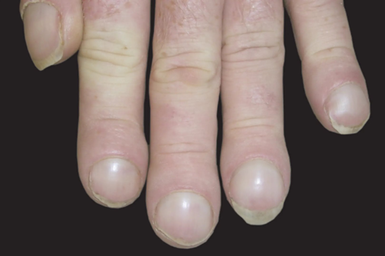 手诊看疾病图解