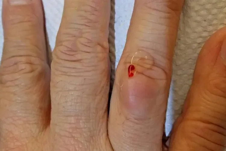 手指关节腱鞘囊肿图片