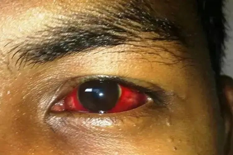 登革热被咬后的图片