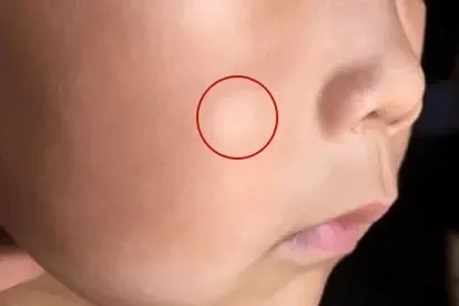 儿童早期轻度白癜风图片