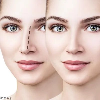 隆鼻有风险吗 隆鼻风险性分析