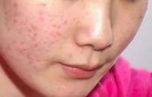 医院祛痘需要多少钱