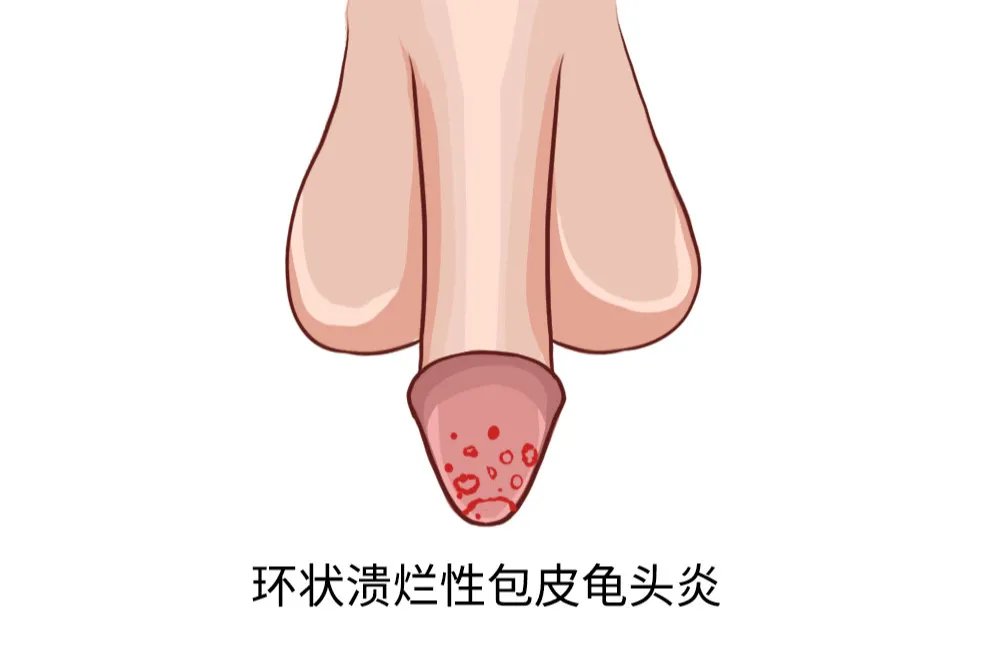 4种龟头炎图片