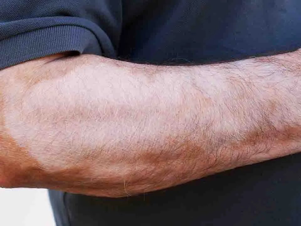 白癜风是怎么引起的呢?