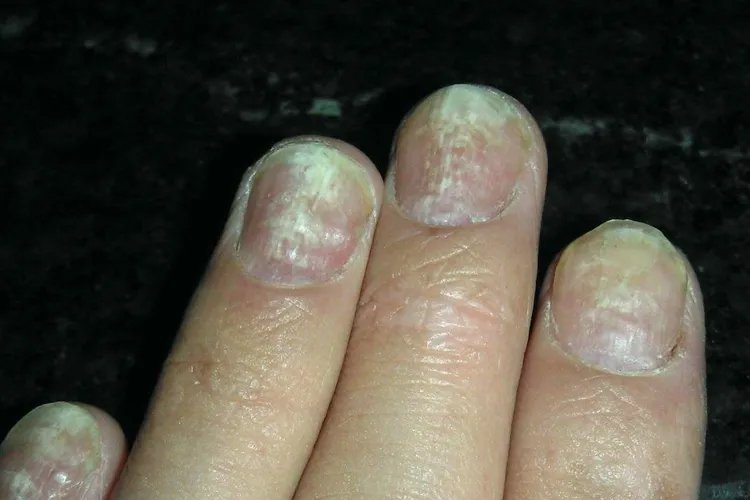 灰指甲图片全图