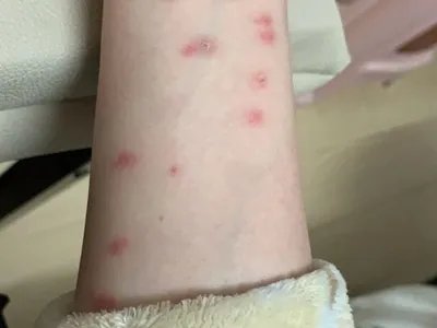 跳蚤叮咬疙瘩图片