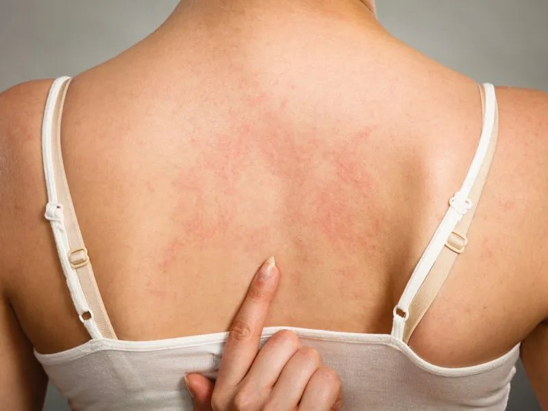 丘疹性湿疹有哪些治疗方法