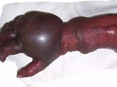 气性坏疽症状图片