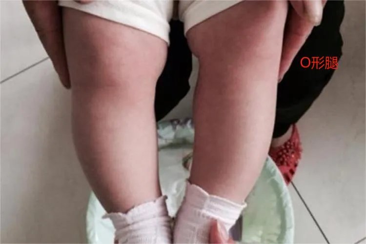 佝偻病是什么样子的图片