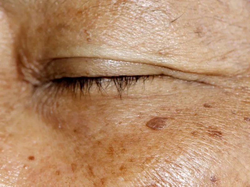 吃什么淡化色斑