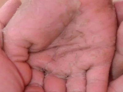 叠瓦癣脱皮图片