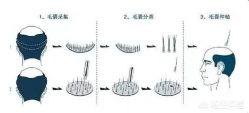 鲁尼植发这件事，大家这么看？