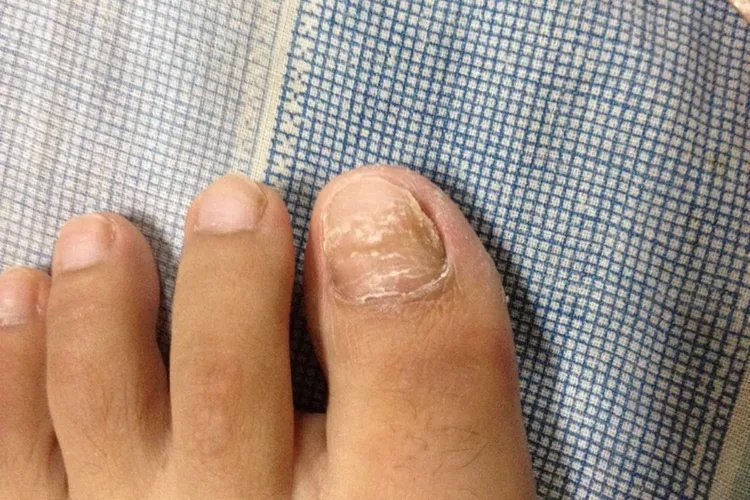 脚趾甲分层裂开图片