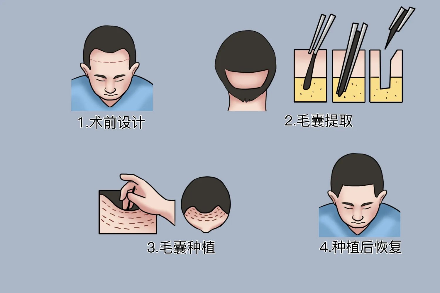 植发图片全过程