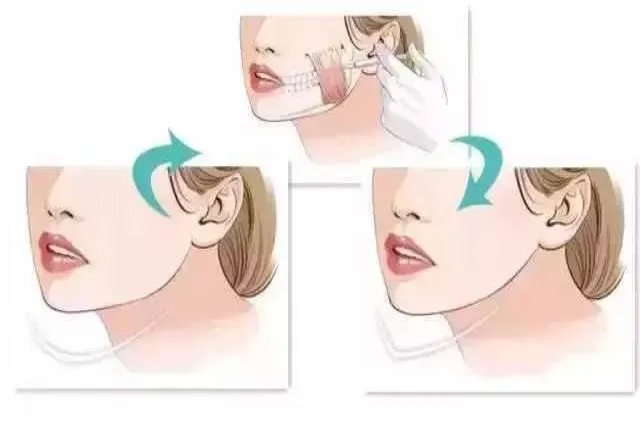 长曲线下颌角整形的图