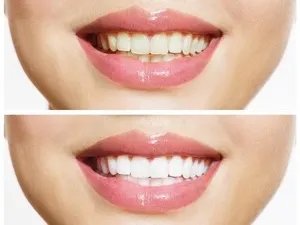 深圳六家齿科冷光美白价格大比拼