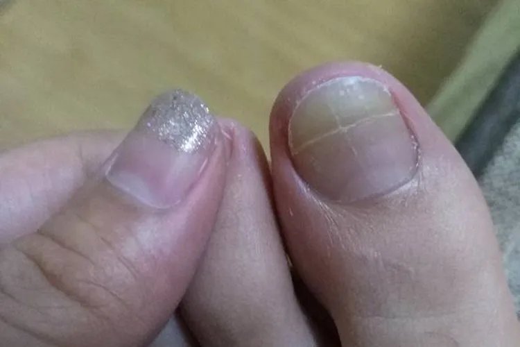 脚趾甲分层裂开图片