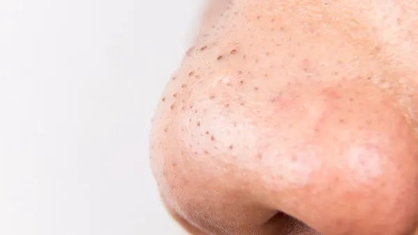 鼻子有黑头怎么办