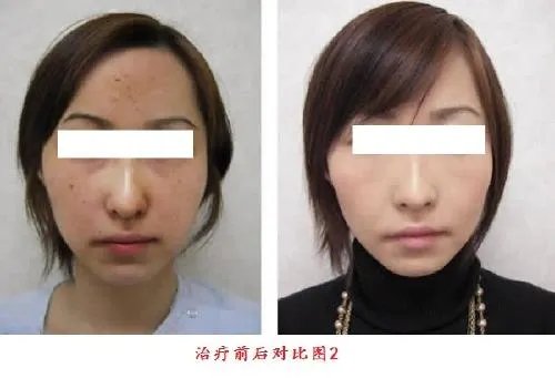 北京彩光嫩肤美白的禁忌人群