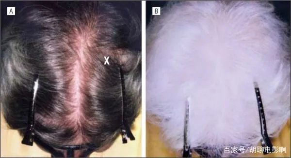 所谓的“一夜白发”的说法，真的有那么夸张吗？