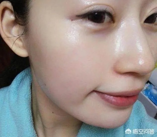 遗传斑点怎么去除？