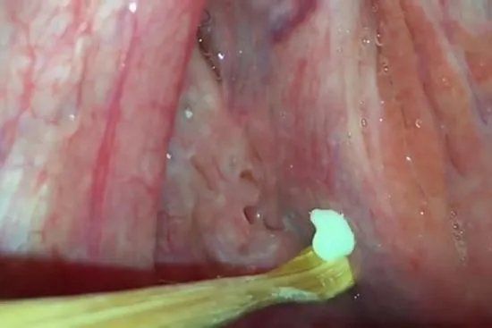 喉咙旁边有个小洞图解