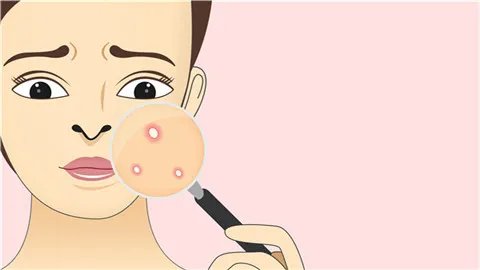 青春痘怎么能治好