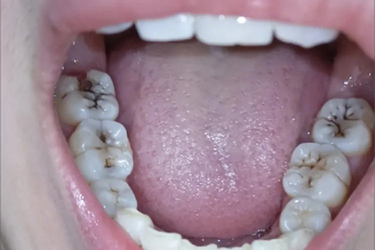 龋病牙齿症状图片