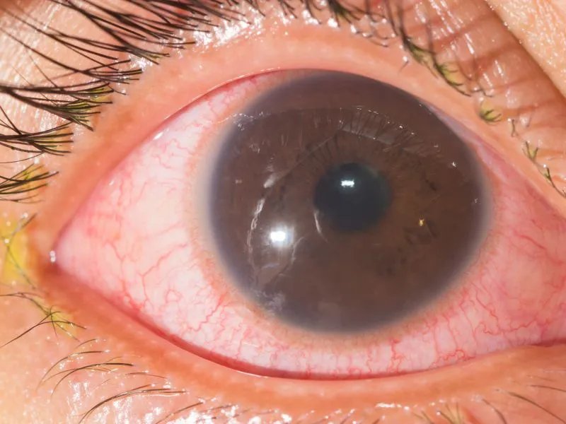 男子瞳孔变心形的原因