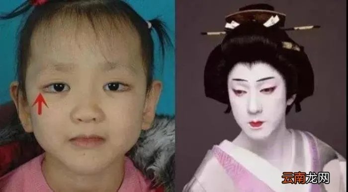 歌舞伎综合征 歌舞伎综合征能活多久