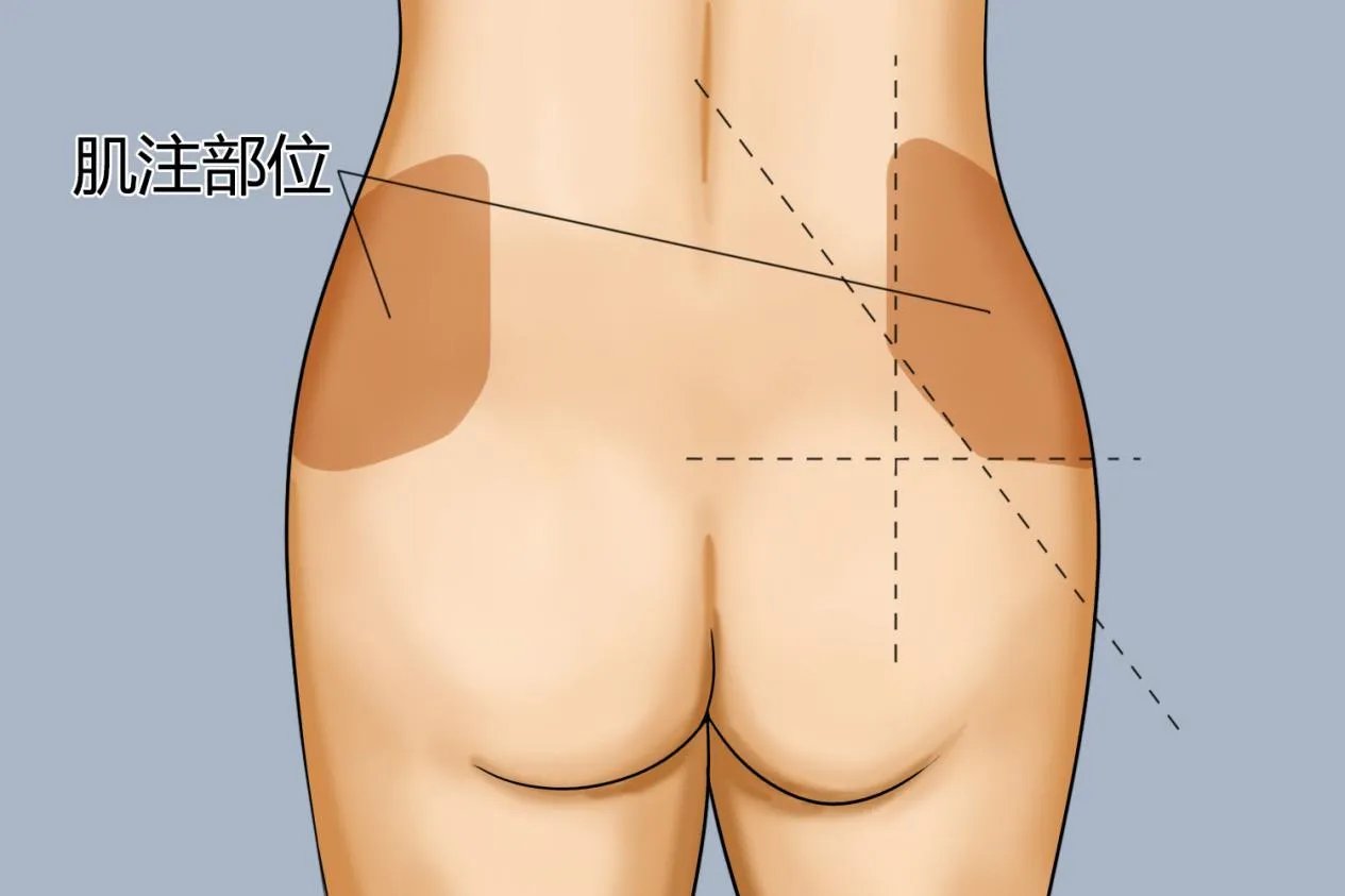 三岁小孩肌肉注射定位图