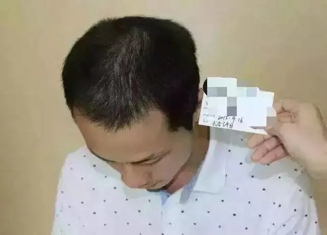 鲁尼植发这件事，大家这么看？