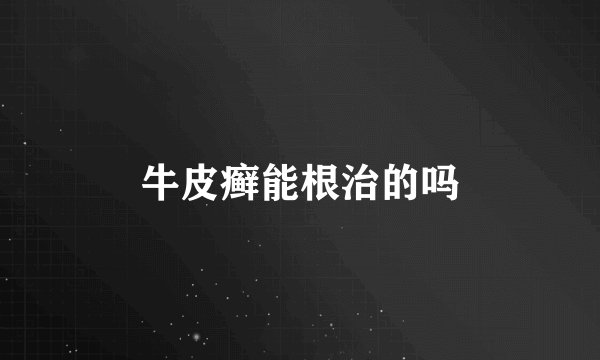 牛皮癣能根治的吗