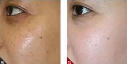 治疗老年斑需要多少钱