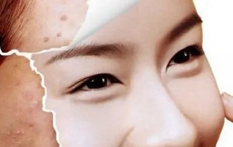 像素激光祛痘印原理	