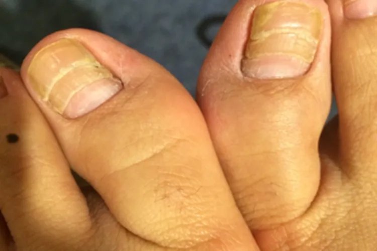 脚趾甲分层裂开图片