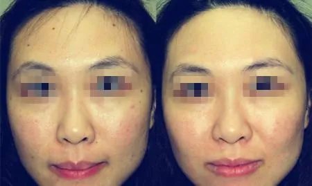 光子嫩肤后会反弹吗