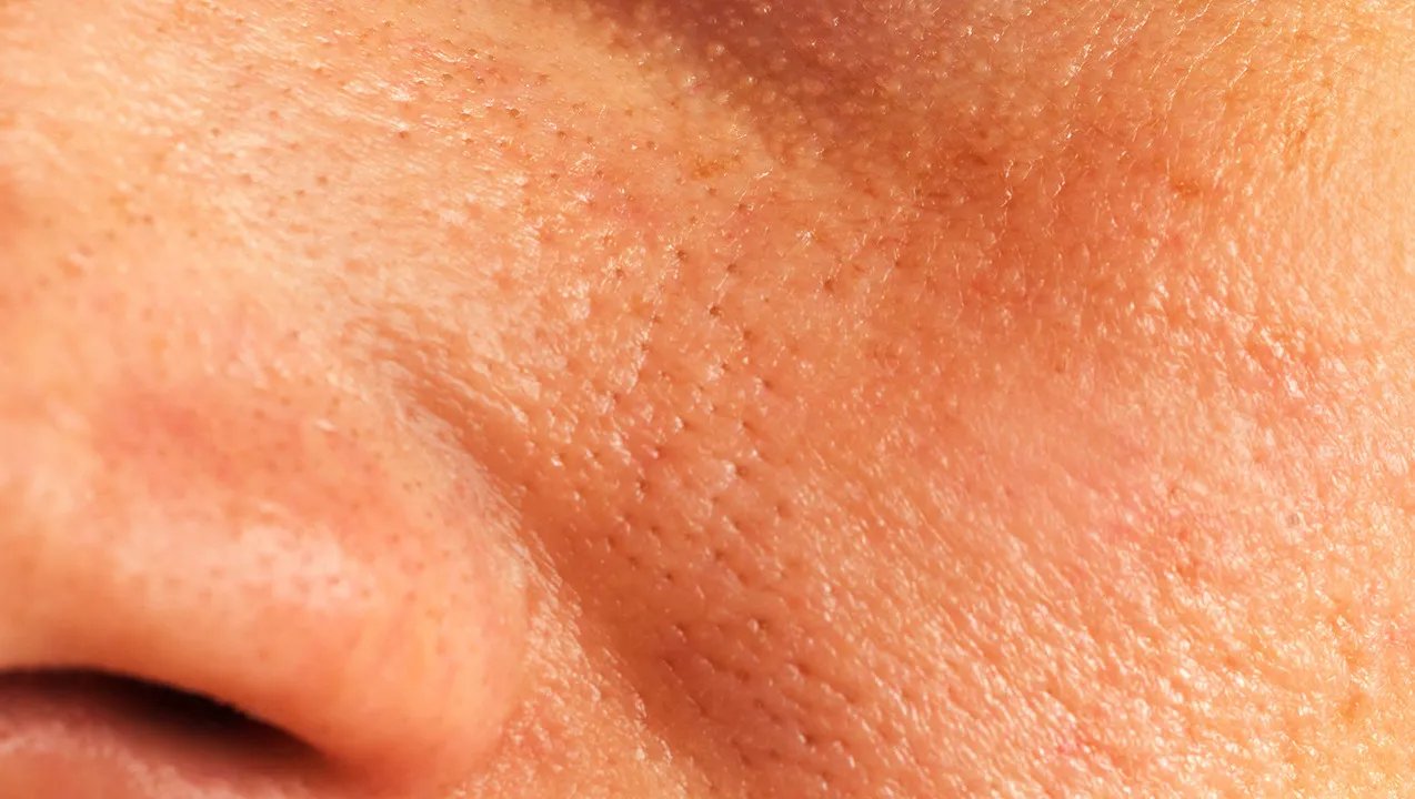 皮肤薄红血丝怎么办