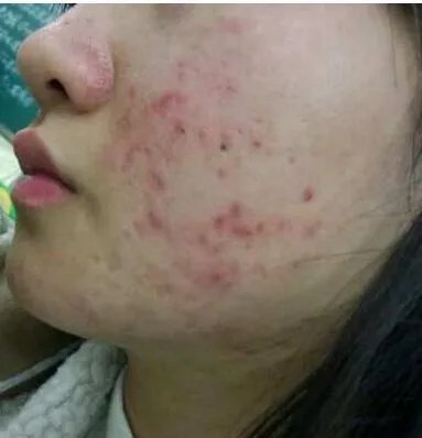 遗传斑点怎么去除？